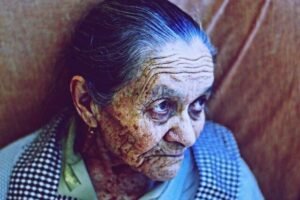 Lewy Body Dementia and Eating Problems